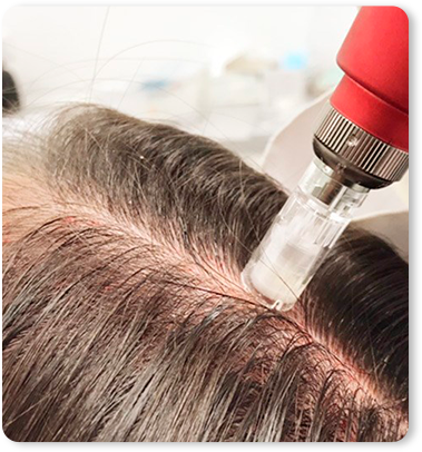 Microneedling con plasma capilar