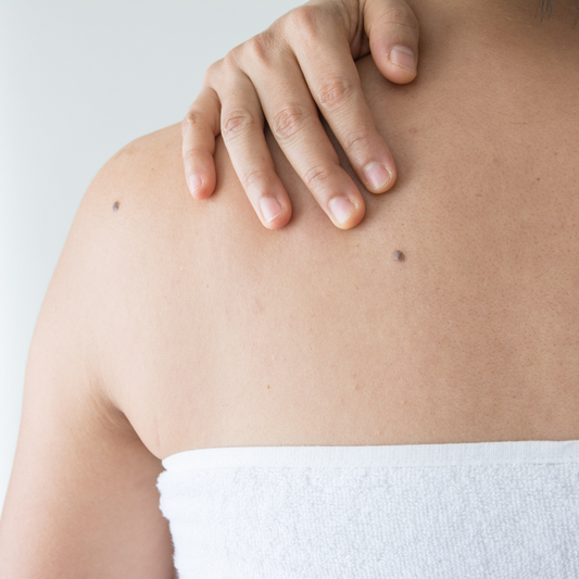 Remoción de nevus y acrocordones